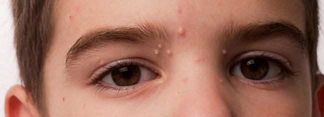 O que é molusco contagioso?