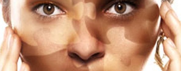 o que é vitiligo?