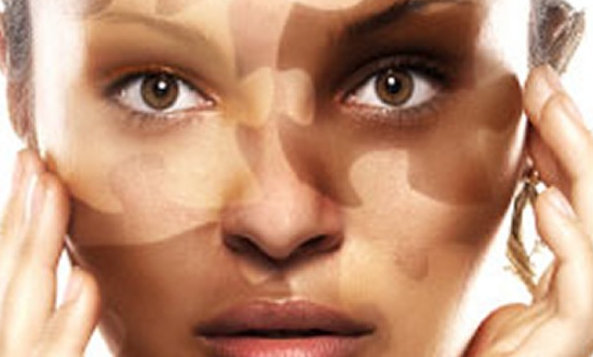o que é vitiligo?