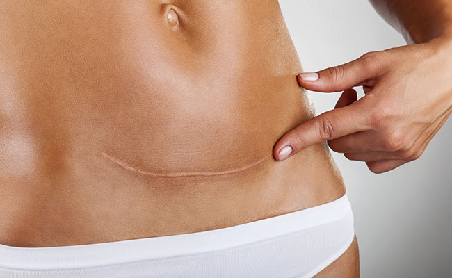 Como funciona o tratamento para queloide?