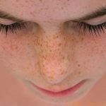 Causas e tratamentos de manchas na pele