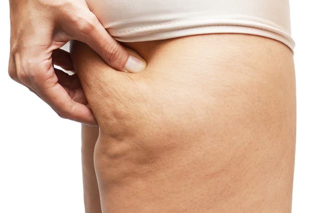 Mulher apresenta celulite no bumbum