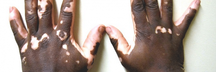 Mãos com vitiligo | Vitiligo tem cura?