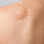 O que é lipoma
