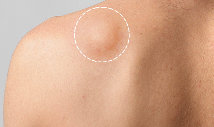 O que é lipoma - Dermatologista Kaliandra Kainelli