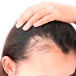 O que é Alopecia Fibrosante Frontal