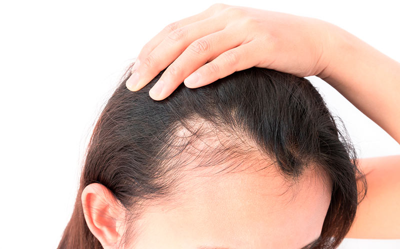 O que é alopecia fibrosante frontal - Dra. Kaliandra Kainelli