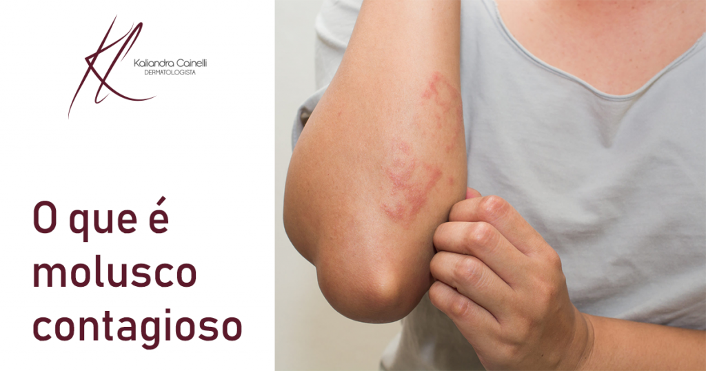 O que é molusco contagioso | Dra. Kaliandra Cainelli
