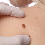 Dezembro Laranja: mês de prevenção ao câncer de pele