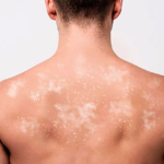 Origem da Hanseníase, causas e tratamentos