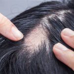 Alopecia: você sabe o que é?